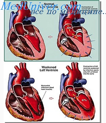 Insuficiență cardiacă în copilăria timpurie