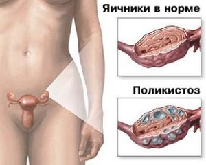 Simptomele, cauzele și tratamentul sindromului epuizării ovarelor