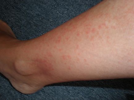 Erupția pe picioare sub formă de puncte roșii la un adult