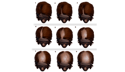 Un algoritm modern pentru tratamentul alopeciei androgenetice