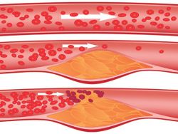 érszűkület (stenosis) érszűkület