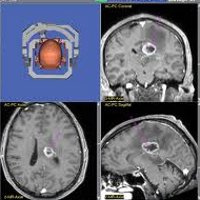 Biopsii stereotactice ale tumorilor cerebrale - prețuri în moscow, 18 prețuri găsite