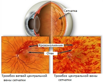 Tromboza venoasă retinală centrală și tratamentul acesteia în mgk