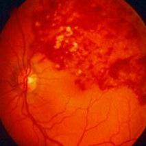 Tromboza venoasă centrală a simptomelor retinei, diagnostic și tratament