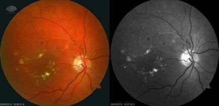 Tromboza venoasă retiniană centrală, simptome, cauze, tratament