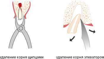 Видалення кореня зуба боляче, як проходить процедура