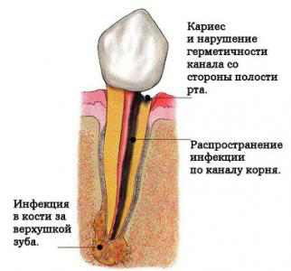 Видалення кореня зуба боляче, як проходить процедура