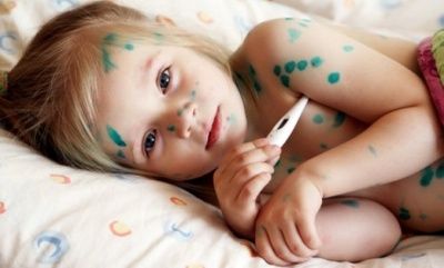 Varicella - simptome și caracteristici la copii și adulți