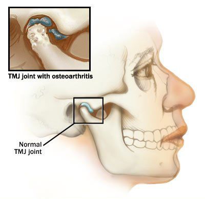 Anchiloza articormală temporomandibulară și tratamentul acesteia
