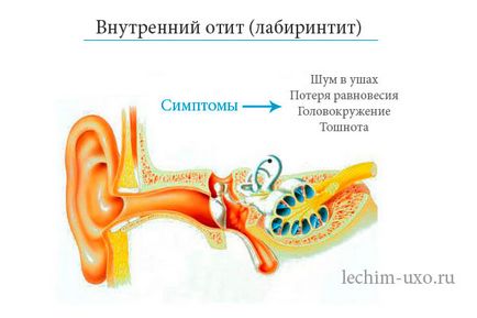 Otita interna (labirint) simptome, tratament, diagnostic