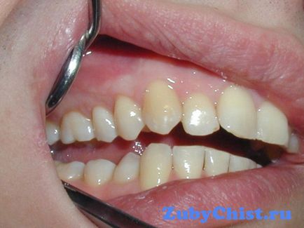 Inflamația și tratamentul pot elimina un dinte inflamat