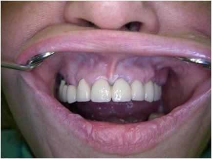 Restaurarea filelor rădăcinii dintelui