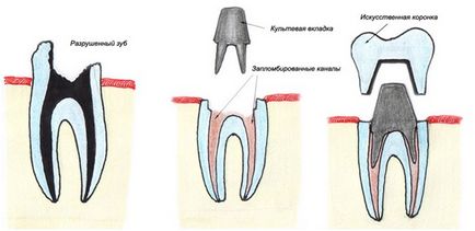 Відновлення кореня зуба вкладками