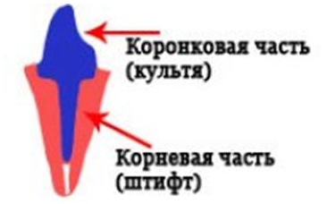 Відновлення кореня зуба вкладками