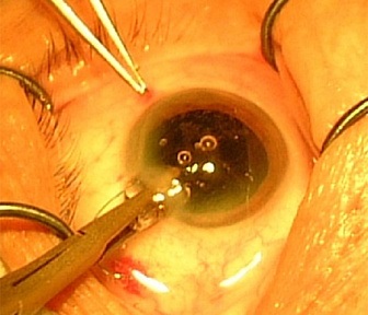 Хірургічне лікування глаукоми в клініці