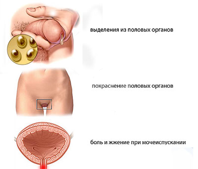 Хламідіоз симптоми і прояви хвороби