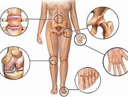 Boli ale articulațiilor și tratamentul acestora cu nsp
