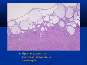 Simptome și tratament pentru hiperplazia endometrială chistică glandulară