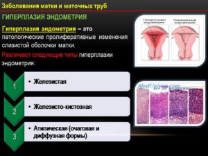 Simptome și tratament pentru hiperplazia endometrială chistică glandulară