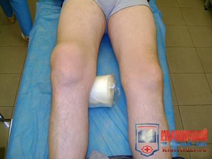 Рідина в колінному суглобі як відбувається відкачування