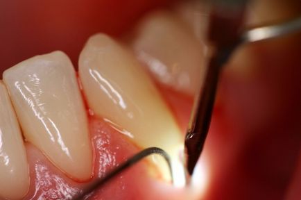 Зуби хитаються що робити, стоматологічна допомога, народна медицина