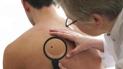 10 perc alatt lehetne megmenteni az életét, vagy hogyan kell védekezni a melanoma