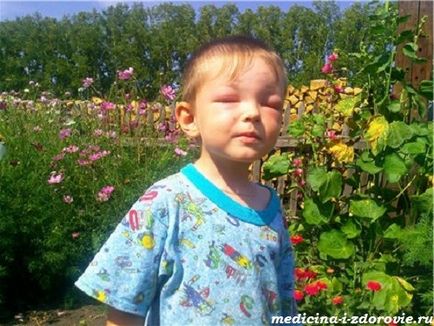 Alergia la cauze reci, simptome, la copii, tratament
