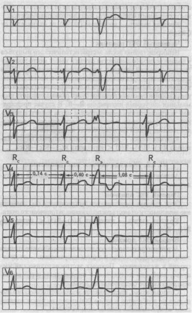 Alfabetul ECG