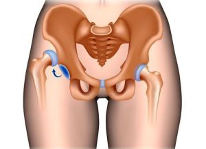 Бандажи, ортези и клечки за тазобедрена става прегледа начина на закрепване на бедрото със снимки