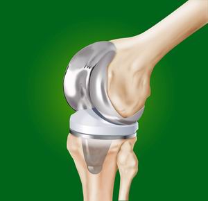 Біопротезуванні колінного суглоба - методи лікування в Німеччині - журнал лікування в Німеччині
