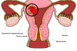endometriumbiopszia
