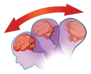 Черепно-мозкова травма наслідки та реабілітація