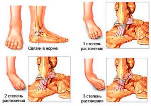 Що робити підвернув ногу перша допомога