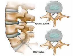 Що це таке циркулярна протрузія дисків хребта