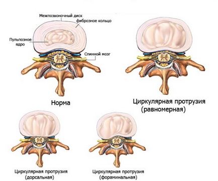 Що це таке циркулярна протрузія дисків хребта