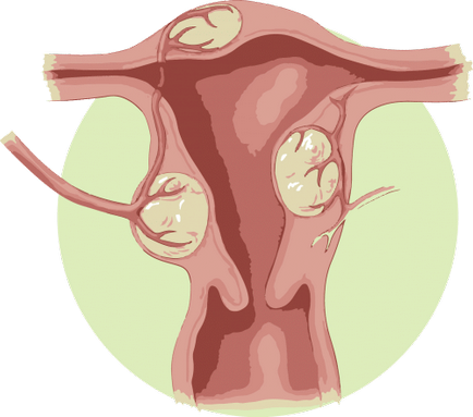 Ce se poate și nu se poate face cu miomul uterin?