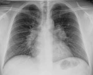 Що таке саркоїдоз легенів і як він проявляється