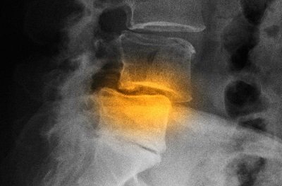 Mi spondylolisthesis a lumbosacral gerinc