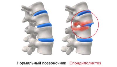 Що таке спондилолистез попереково-крижового відділу хребта