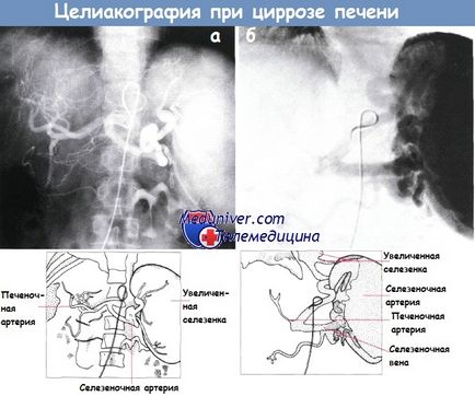 Ciroza hepatică