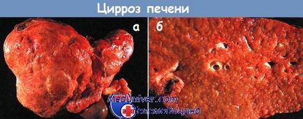 Ciroza hepatică