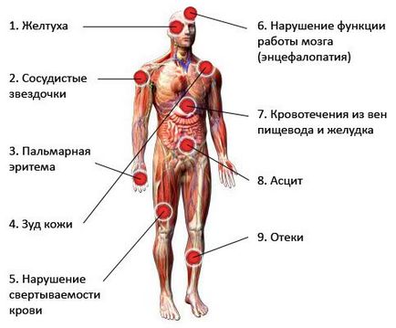 Цироз печінки - причини, симптоми і лікування цирозу