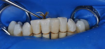 Revizie dentară, articole, cimenturi compozite ortopedice, autoadezive, în practică ortopedică
