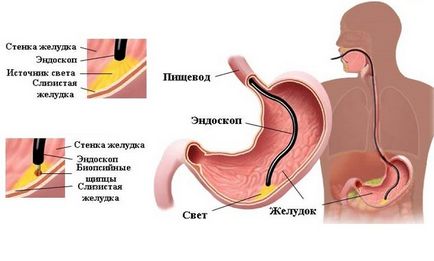 Гастроскопия шлунка показання, підготовка і порядок проведення