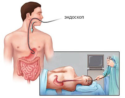 Gastroscopia stomacului, indicații, pregătire și procedură