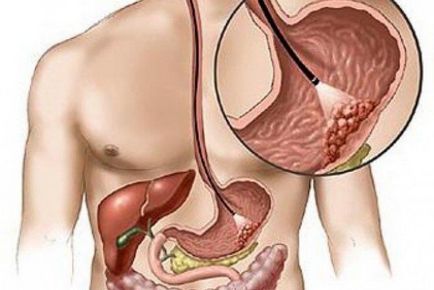 Gastroscopia stomacului, indicații, pregătire și procedură