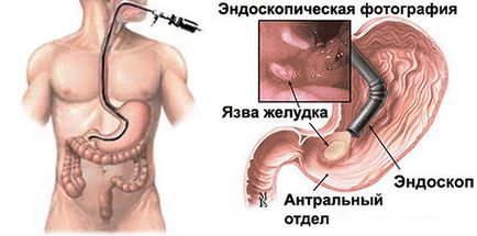 Gastroscopia stomacului, indicații, pregătire și procedură