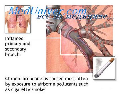 Hiperreactivitatea bronhiilor în inflamația lor