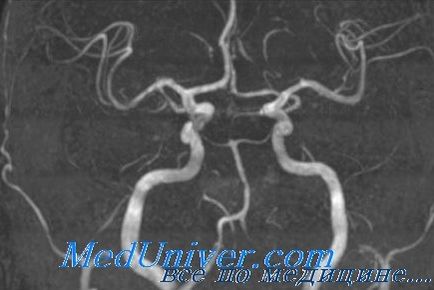 Amețeli cu clinica de atac ischemic tranzitor (tia), diagnostic, tratament