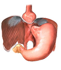 Hiatus hernia tünetei, diéta, kezelés